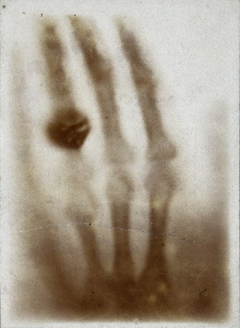 Hand mit Ringen: Wilhelm Röntgen's x-ray of his wife's hand